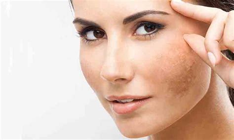 Apa Perbedaanya Melasma Flek Freckles Dan Hiperpigmentasi Eva