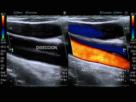 Aortic Dissection Ultrasound