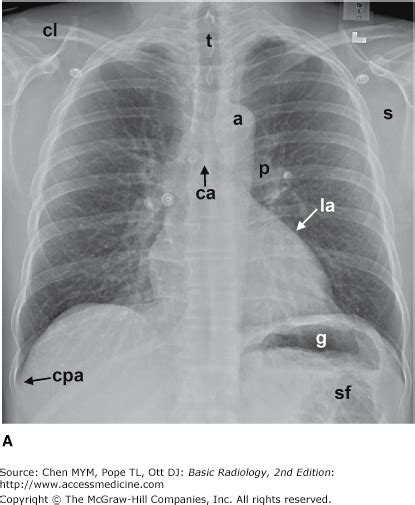 Carina Chest X Ray