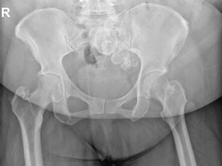 Calcified uterine fibroids | Radiology Case | Radiopaedia.org