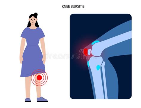 Knee Bursitisdeep Infrapatellar Bursitis Stock Vector Illustration