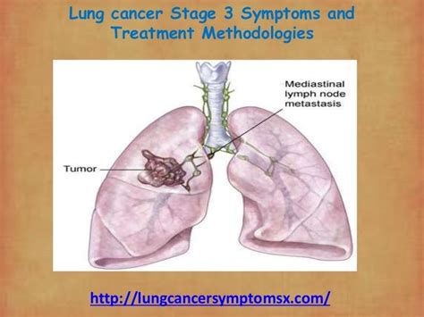 Lung cancer stage 3 symptoms and treatment methodologies