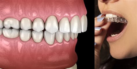 Can Invisalign Fix Overbite Gary Login DMD