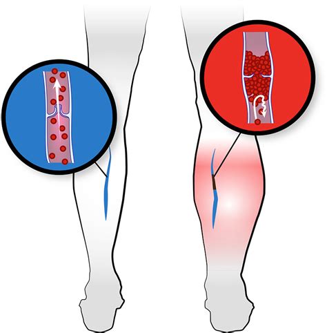 Deep Vein Thrombosis DVT