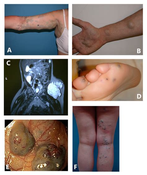 Figure Various Venous Malformations Vm Genereviews Ncbi