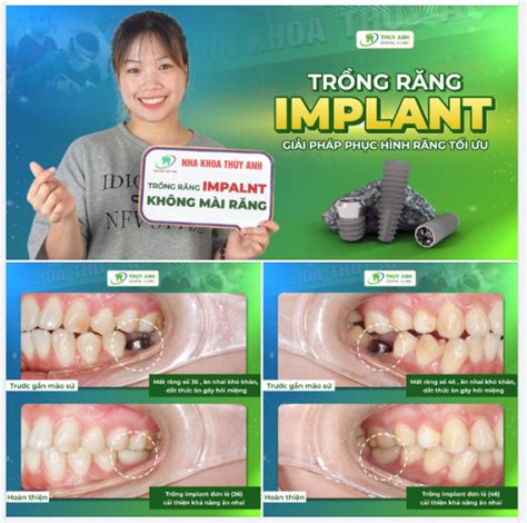 Trồng răng implant bao lâu thì ăn được Nha khoa Thùy Anh Nha khoa