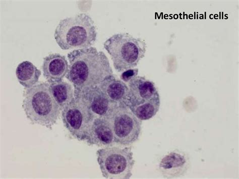 Fluid Cytology In Serous Cavity Effusions