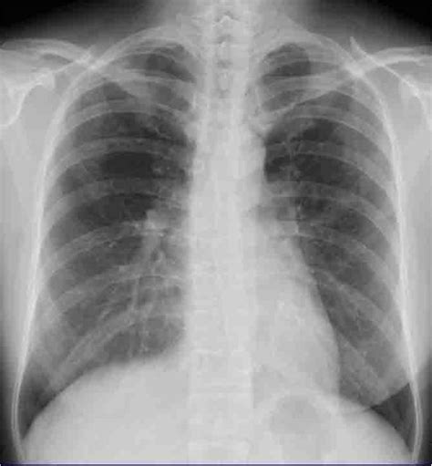 The Chest X Ray Shows Slight Peripheral Infiltration Shadows In Both