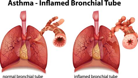 Understanding Asthma Asthma Canada