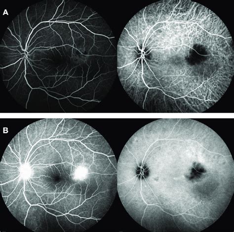 Fluorescein Angiography Left Showed Hypo Fluorescence In Early Phase Download Scientific