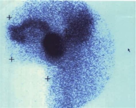 Tc 99m Pertecnetate Scintigraphy Of Lingual Thyroid Anteroposterior