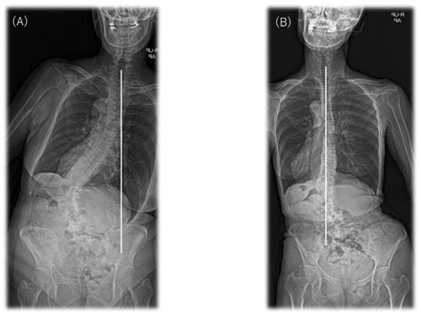 JCM Free Full Text Postoperative Radiological Improvement After