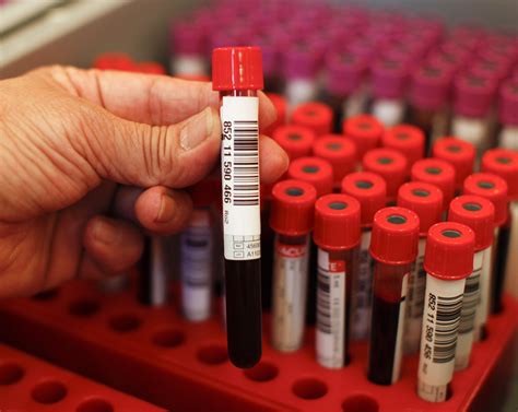 First 'Blood Test for Depression' Holds Promise of Objective Diagnosis