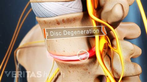 Lumbar Degenerative Disc Disease Overview Causes And Symptoms