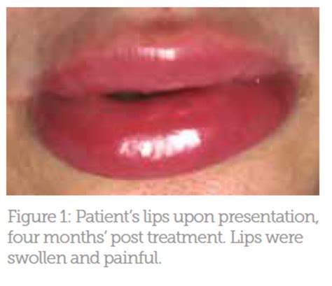 Case Study Lip Filler Infection And Nodules Aesthetics