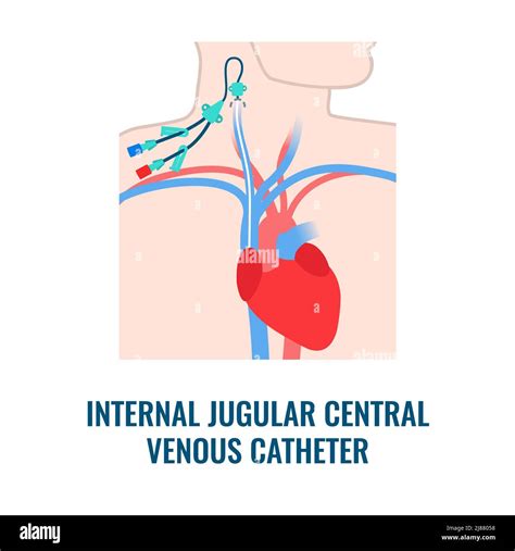 Central Venous Catheter Banque Dimages Détourées Alamy