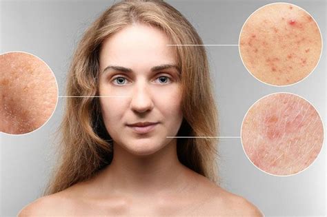 Detailed Informations About Hyperpigmentation Top Acne Treatments Review