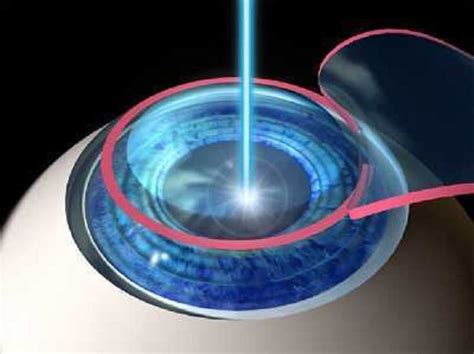 Lasik And Vision Surgery Eye Health Central