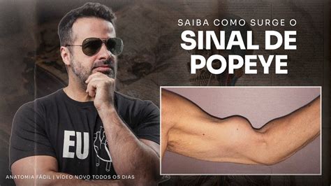 Como Surge O Sinal De Popeye No Biceps Entenda Tudo Anatomiafacil Youtube