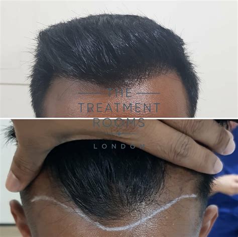 Planning Your Hairline FUE Hair Transplant | Hair Transplant ...