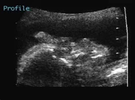 Cyclopia Ultrasoundpaedia