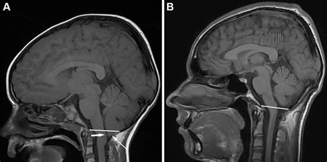 chiari  deformity   mm   foramen magnumradiographics