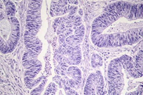 Stage I Esophageal Squamous Cell Carcinoma Surgery Vs