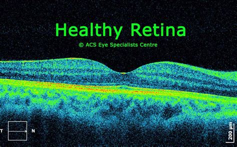 ACS Eye Specialists - OCT - Optical Coherence Tomography used for scanning the retina to ...