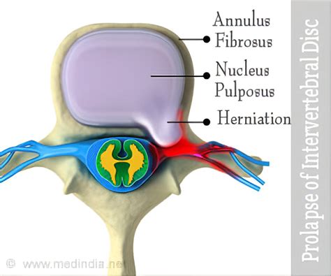 Intervertebral Disc Herniation