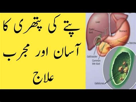 Pitty Ki Pathri Ka Ilaj Gallbladder Stones Treatment Ik Official