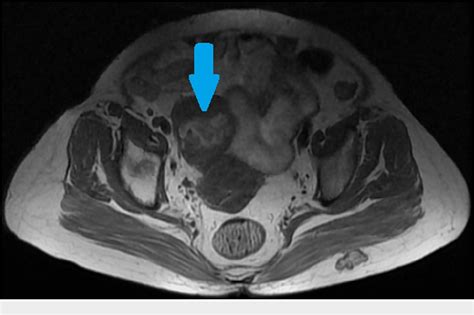 Figure 1 From A Rare Case Of Granulosa Cell Tumor Associated With