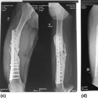 Radiography Of Subject 1 A Preoperative Femoral Radiography B