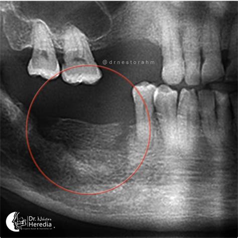 Osteoradionecrosis Of The Jaw Dr Néstor Heredia