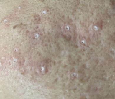 Tca Cross Acne Scars Apax Medical Aesthetics Clinic