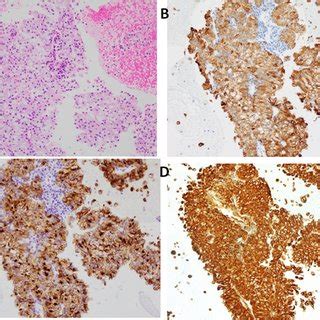 Pathological findings of lymph node biopsy (magnification x20). (A)... | Download Scientific Diagram