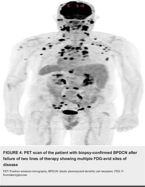 Figure From Venetoclax And Azacitidine In The Treatment Of Blastic