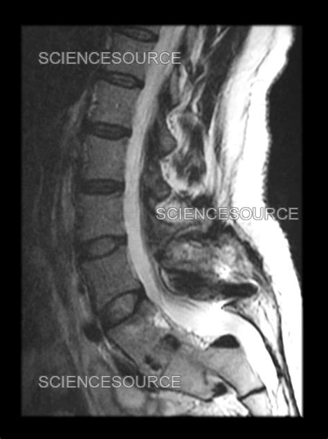 Spondylolysis Mri