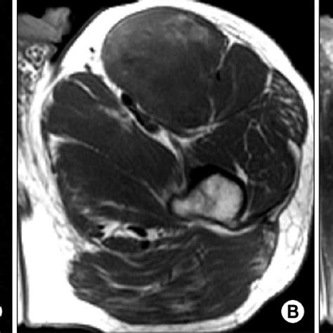 A Axial T2 Weighted Fat Saturated Image B Axial T1 Weighted Image