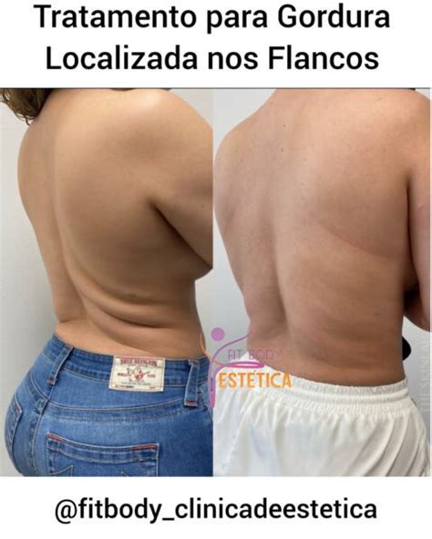 Gordura Localizada Nos Flancos Tratamento Cl Nica Fit Body Est Tica