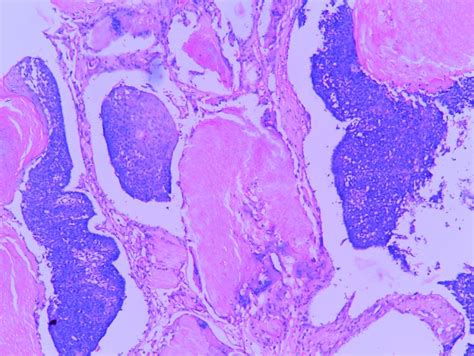 PILOMATRICOMA – Histopathology.guru