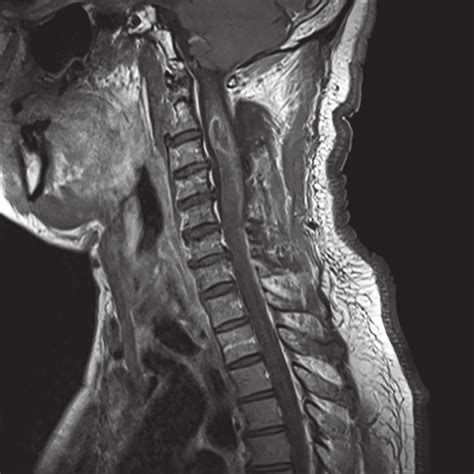 Preoperative Sagittal Contrast Enhanced T1 Weighted Mri Reveals The