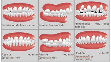 Tratamiento de ortodoncia desde niños a adultos Dentisalut