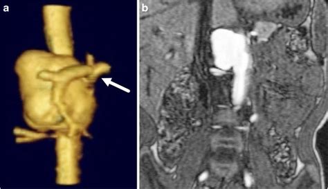 Tuberous Sclerosis Complex And A Saccular Abdominal Aortic Aneurysm In