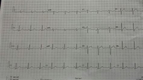 Hi Doc, I had my EKG yesterday and it came out abnormal with