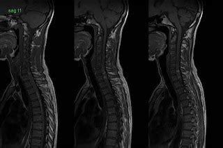 Dr Balaji Anvekar FRCR: Multiple Brain and a Spinal Cavernous ...