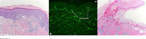 Figure 1 From Toxic Epidermal Necrolysis Like Cutaneous Lupus In