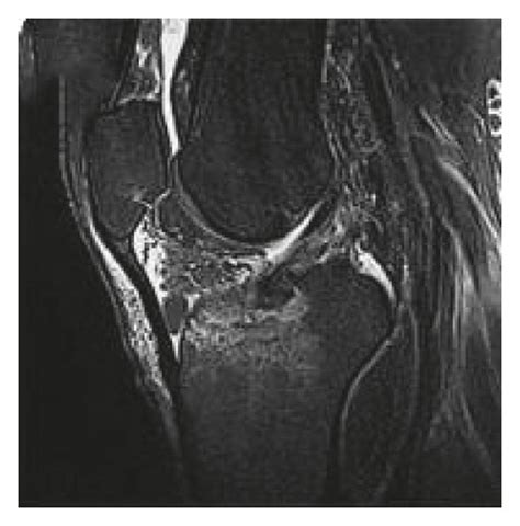 Mri Image Of Meniscus A Mri Image Of Normal Meniscus B Mri Image