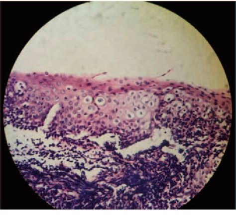 Figure 1 From Human Papillomavirus Causing Tonsillar Hypertrophy In Non