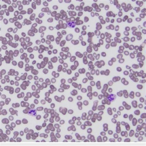 Patient S Peripheral Smear Showing Multiple Hypersegmented Neutrophils