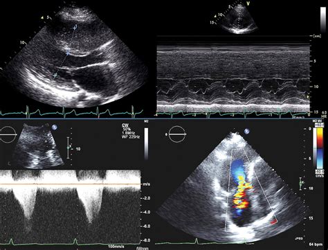 Hypertrophic Obstructive Cardiomyopathy The Lancet